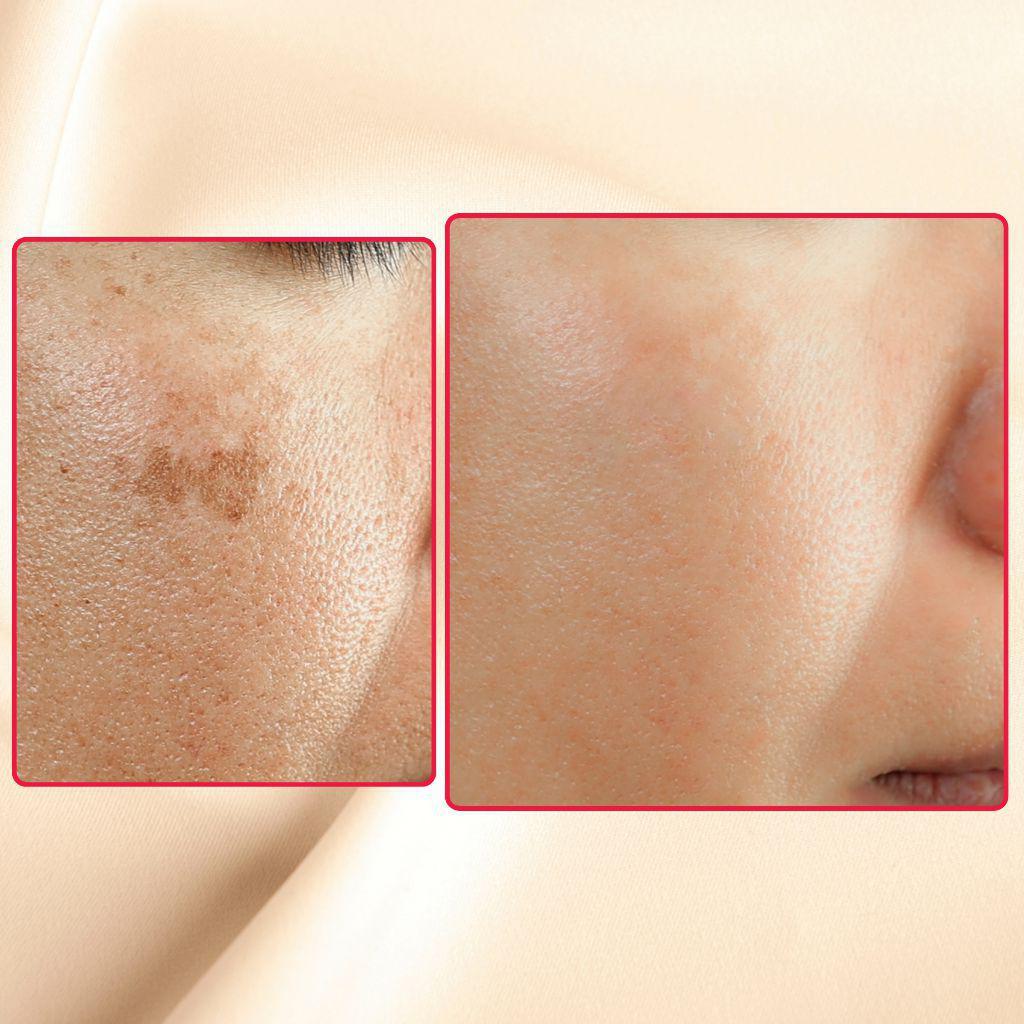 Acid Peel Eraser Combo from gymsegbë