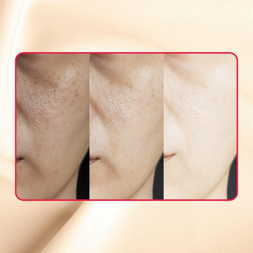 Acid Peel Eraser Combo from gymsegbë