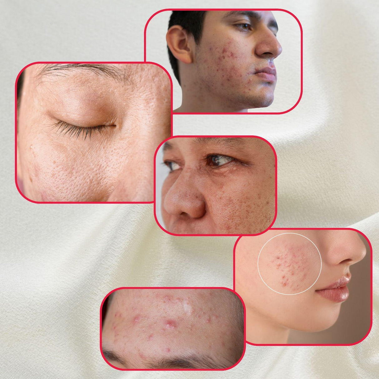 Perfect Trifecta Acne Peel from gymsegbë