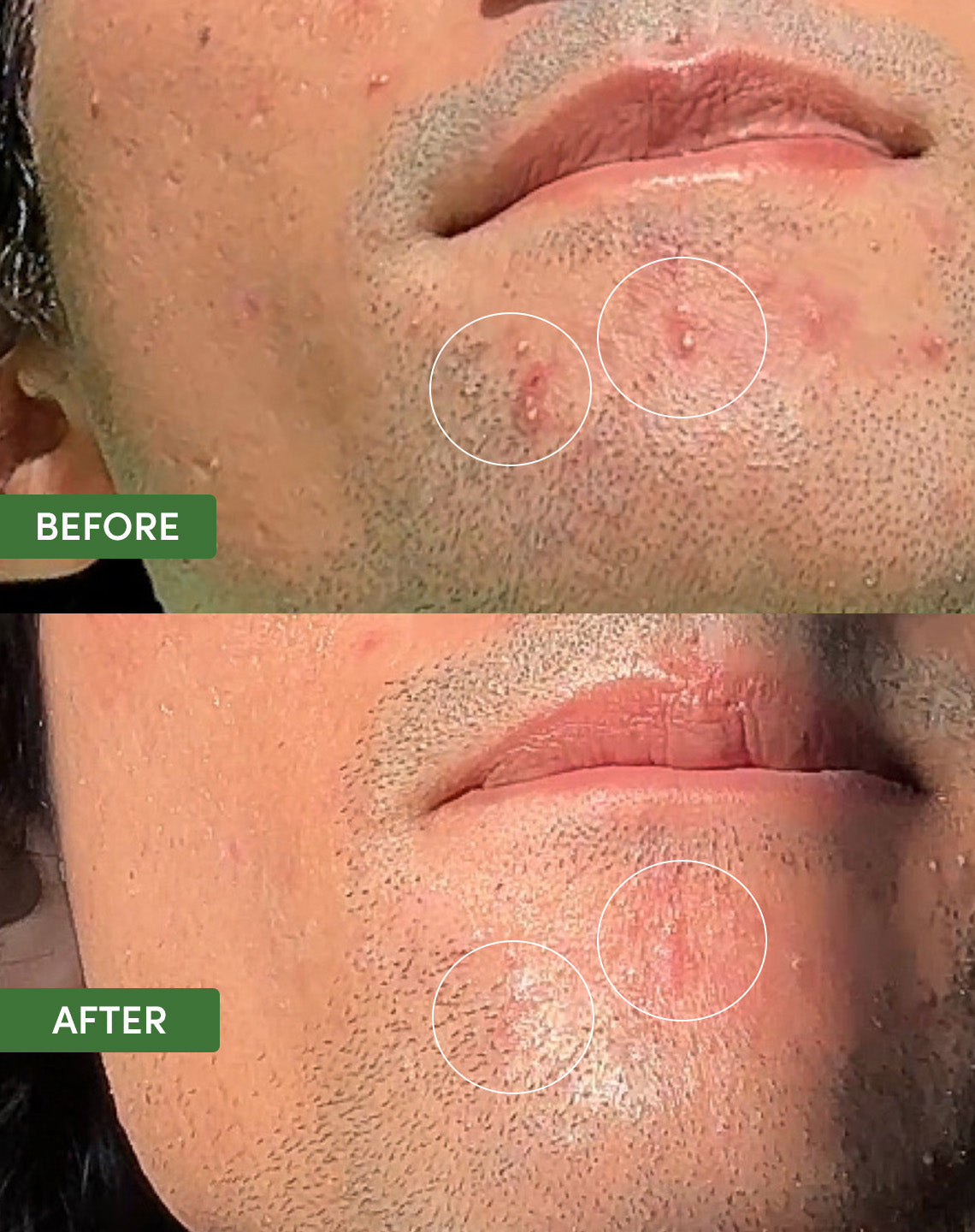 Oil Control Dual Action Blemish Patches From Sand and Sky