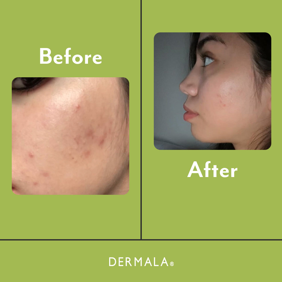 SCANTILY Pad® from Dermala