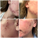 Pregnancy Acne Treatment Kit From The Spoiled Mama