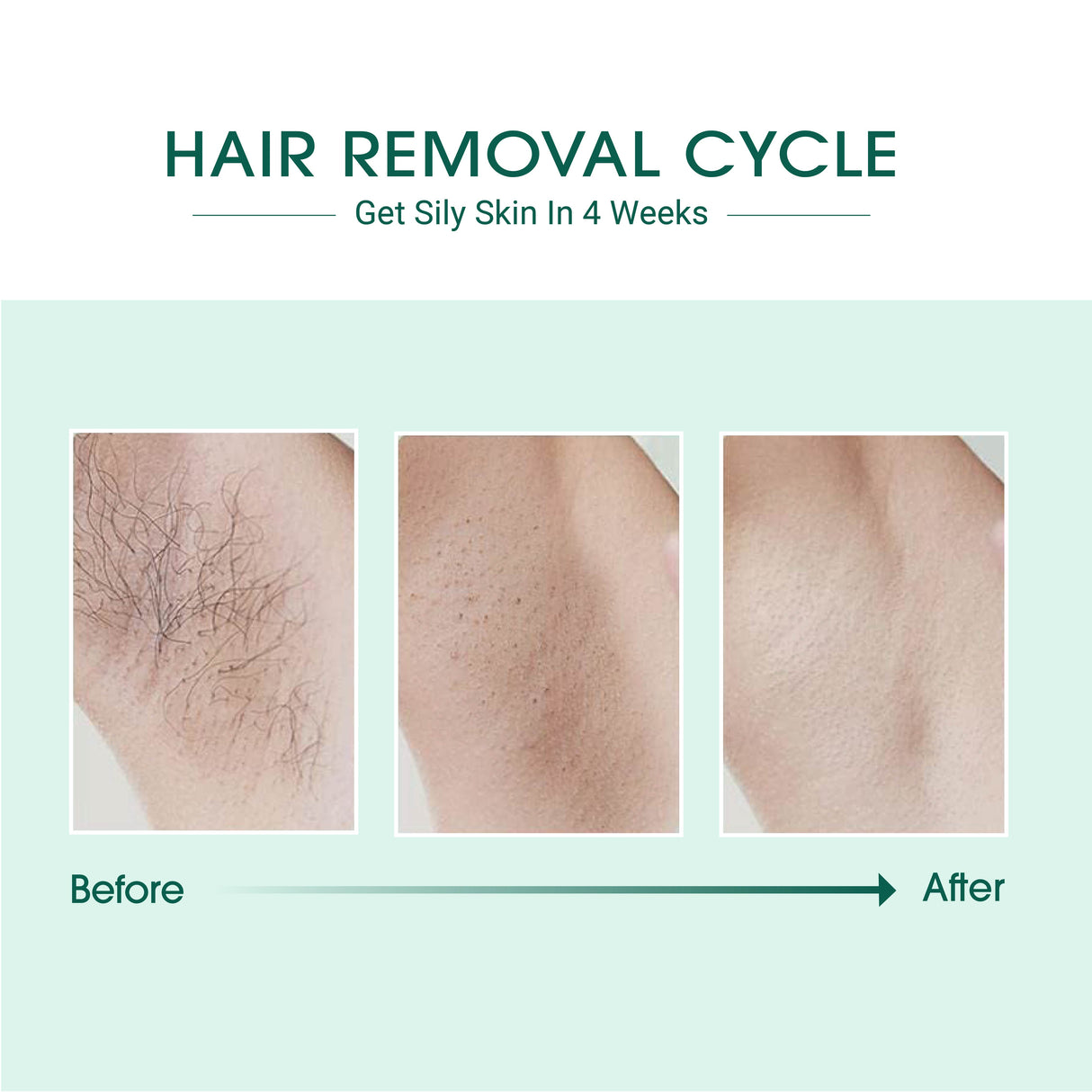 Laser IPL Hair Removal from BeNat