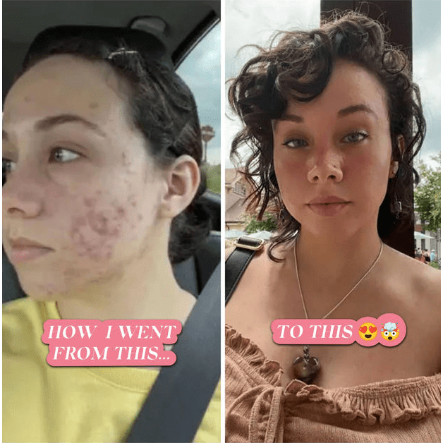 BalanC Pregnancy Acne Toner From The Spoiled Mama