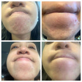 Rehab Serum: Pregnancy Acne Treatment From The Spoiled Mama