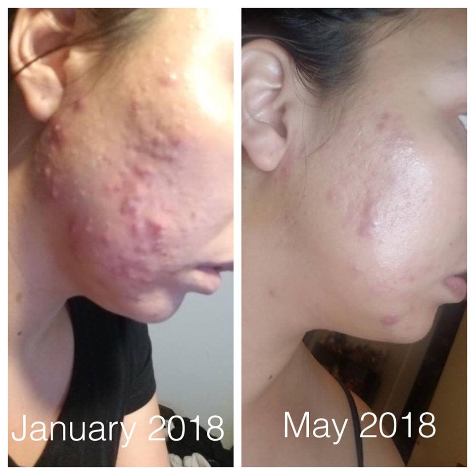 Super Acne Fighter / Organic Acne Treatment / Acne / Essential Oils / Natural  Acne Treatment / Acne Scars / Hormonal Acne / Cystic Acne From Butter Me Up Organics