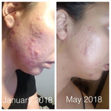 Super Acne Fighter / Organic Acne Treatment / Acne / Essential Oils / Natural  Acne Treatment / Acne Scars / Hormonal Acne / Cystic Acne From Butter Me Up Organics