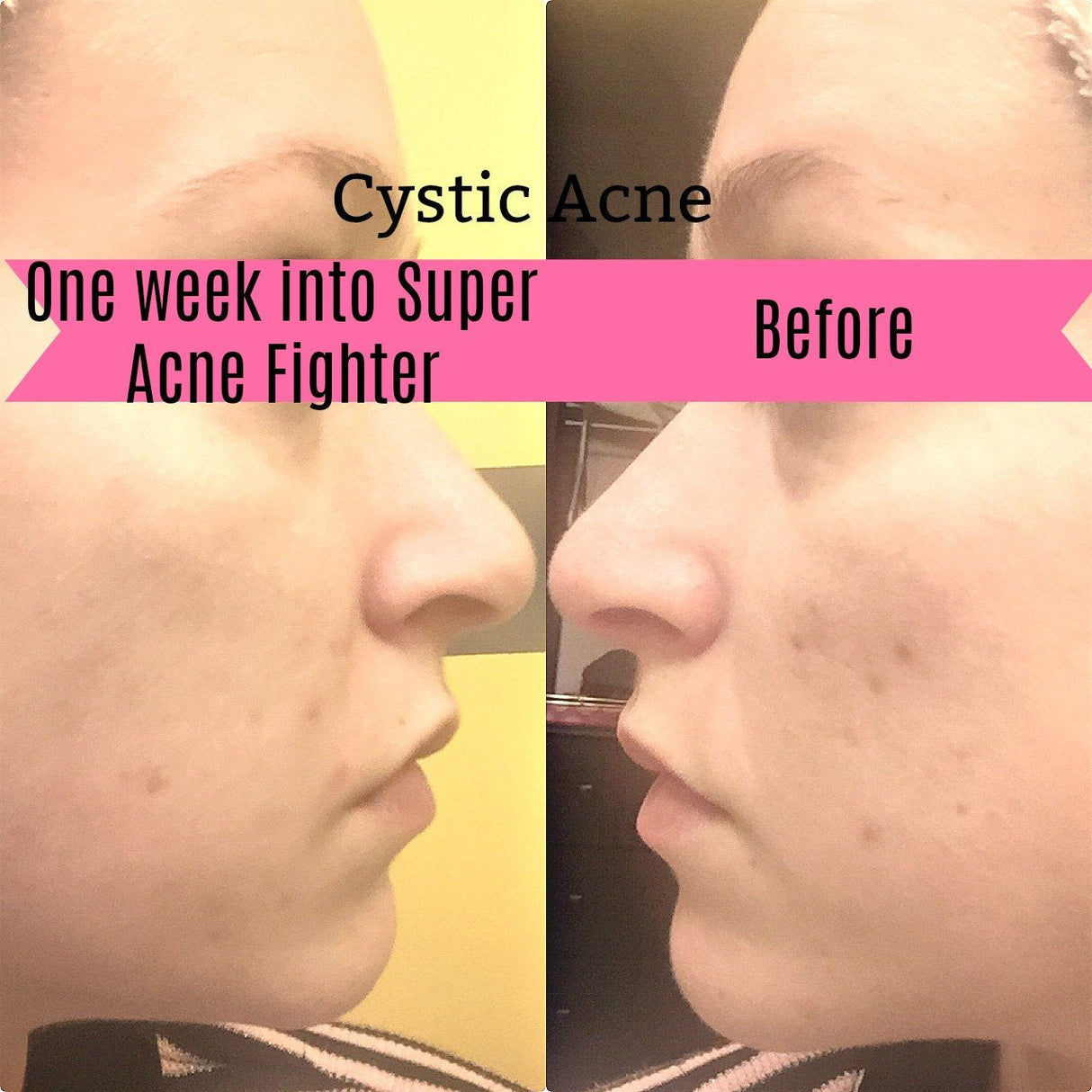 Super Acne Fighter / Organic Acne Treatment / Acne / Essential Oils / Natural  Acne Treatment / Acne Scars / Hormonal Acne / Cystic Acne From Butter Me Up Organics