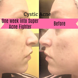 Super Acne Fighter / Organic Acne Treatment / Acne / Essential Oils / Natural  Acne Treatment / Acne Scars / Hormonal Acne / Cystic Acne From Butter Me Up Organics