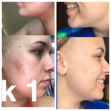 Super Acne Fighter / Organic Acne Treatment / Acne / Essential Oils / Natural  Acne Treatment / Acne Scars / Hormonal Acne / Cystic Acne From Butter Me Up Organics